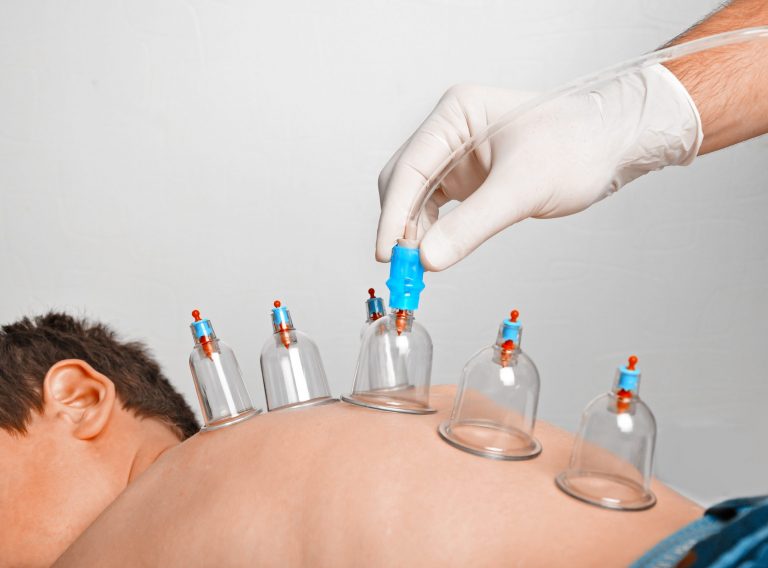 Hijama,-,Bloodletting.,Alternative,Medicine-hacamat